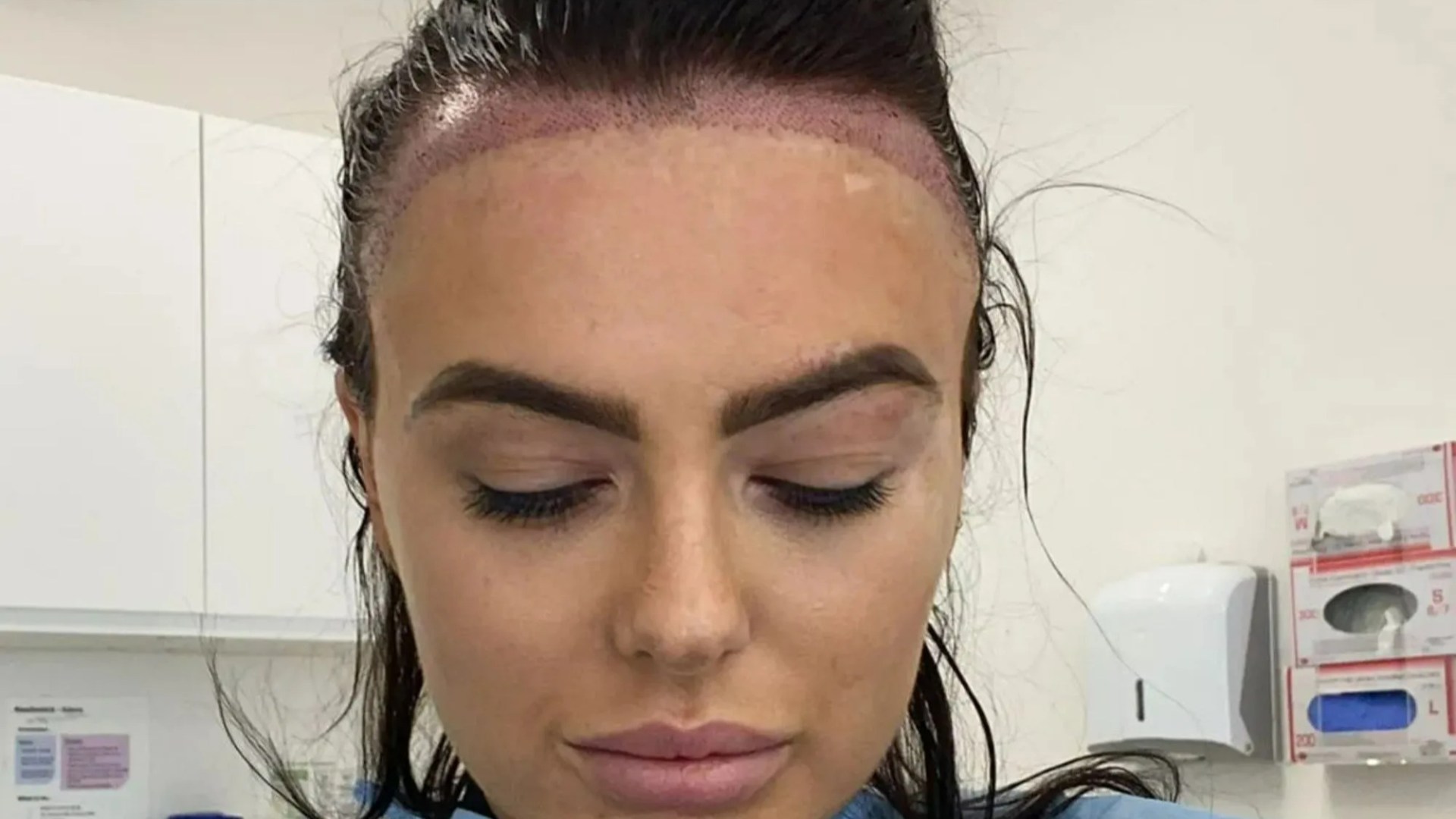 Transformasi Transplantasi Rambut yang Mengubah Selebriti